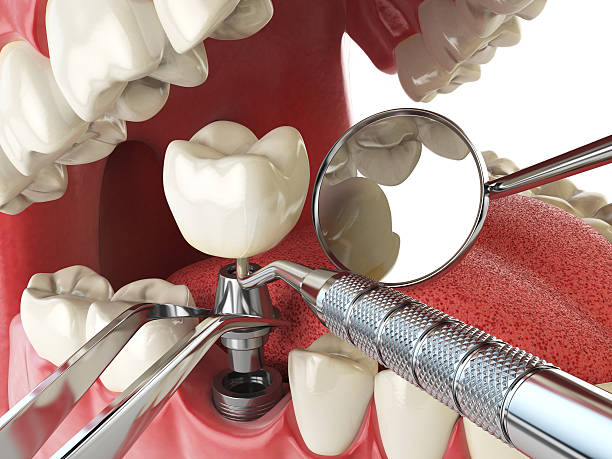 Best Emergency Tooth Extraction in Flora, IN