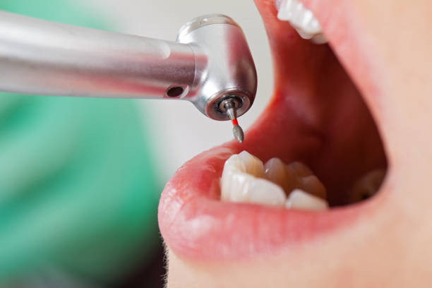 Best Emergency Dental Care for Broken or Chipped Teeth in Flora, IN